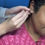 Unidade de Saúde inicia grupo de auriculoterapia